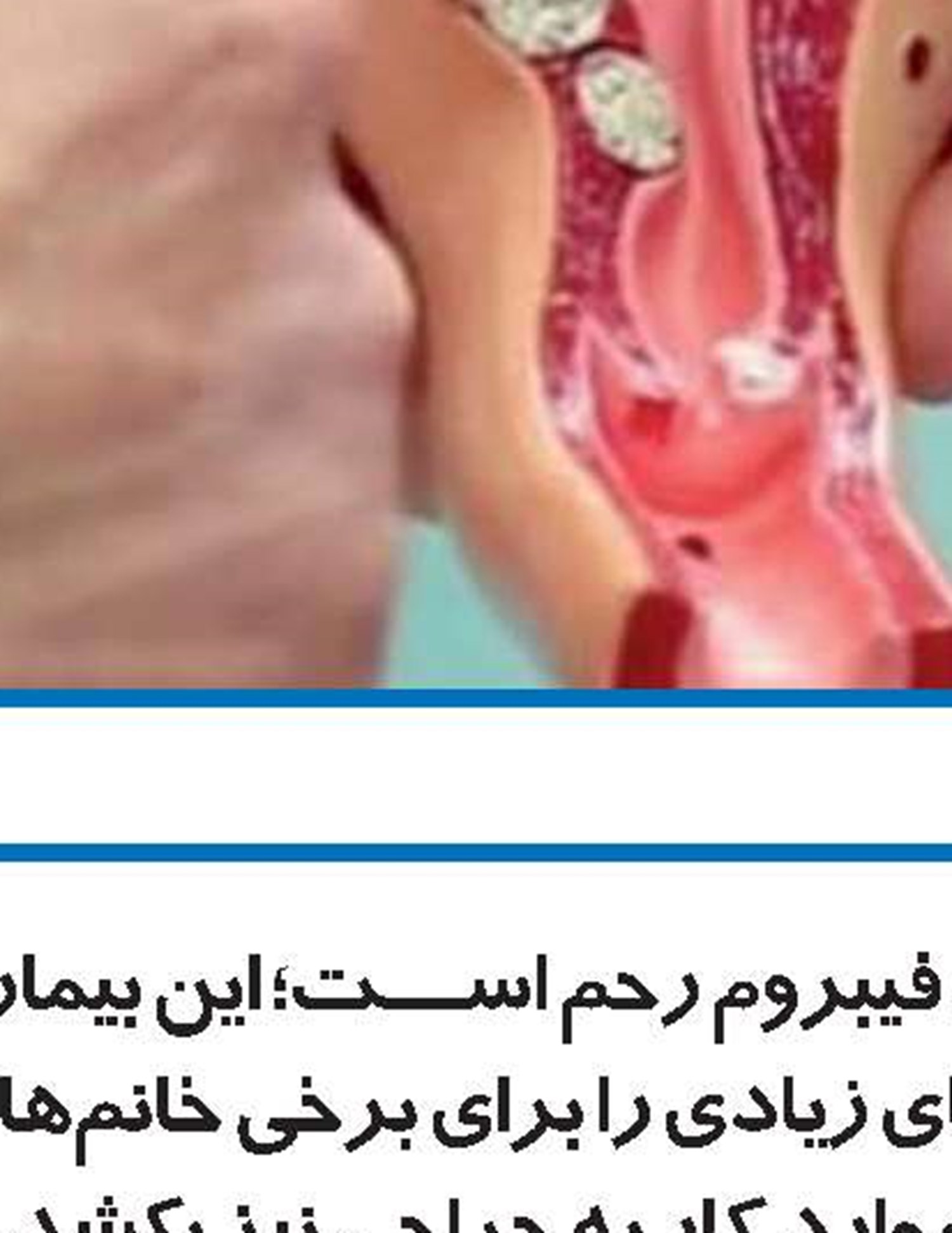 فیبروم رحم چیست؟
